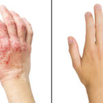 A hand before and after psoriasis treatment