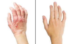 A hand before and after psoriasis treatment