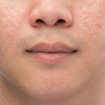 man with acne scars