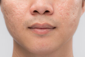 man with acne scars