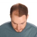 Half of a man's head shows his hair before hair loss treatment and the other, full side shows after