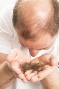 A balding man holds hair he has lost in his hands in front of him